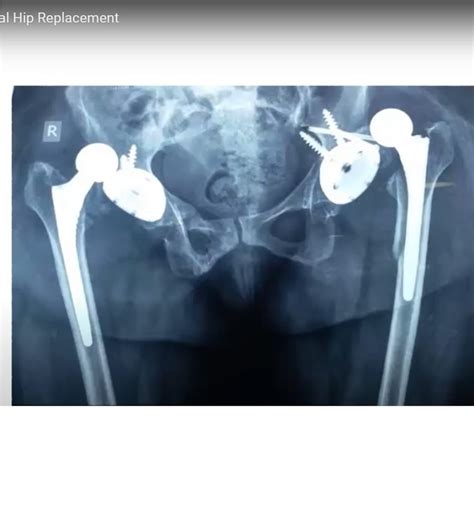 Pelvis And Hip Joint Problem Dislocation After Total Hip Replacement