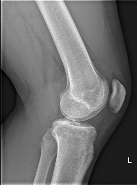 A typical sign on a plain knee radiograph | The BMJ