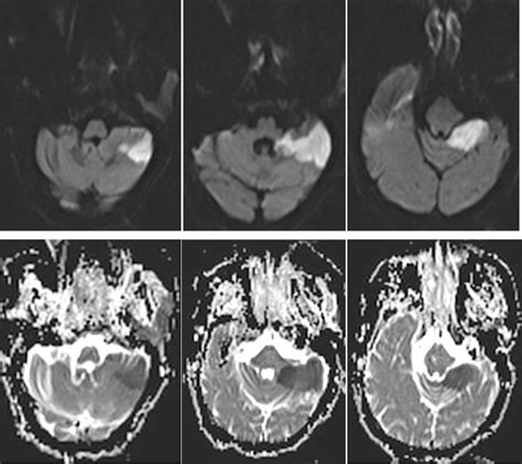 Superior Cerebellar Artery Infarction Radiology Cases