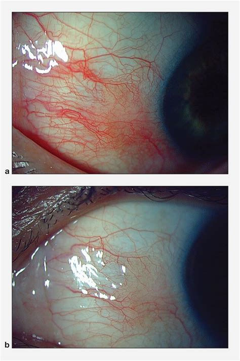 Scleritis And Episcleritis American Academy Of Ophthalmology