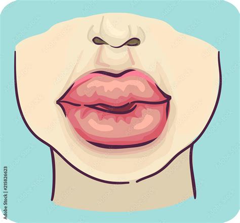 Symptoms Swelling Lips Illustration Stock Vector Adobe Stock