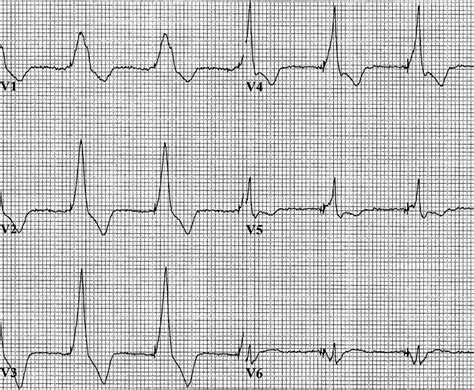 A Case Of Endocarditis Diagnosed By Ekg Shm Abstracts