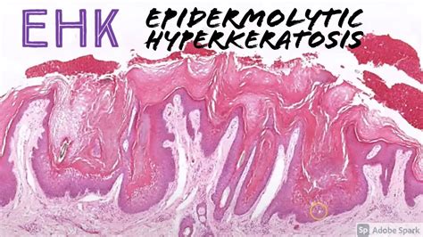 Epidermolytic Hyperkeratosis Ehk 5 Minute Pathology Pearls Youtube