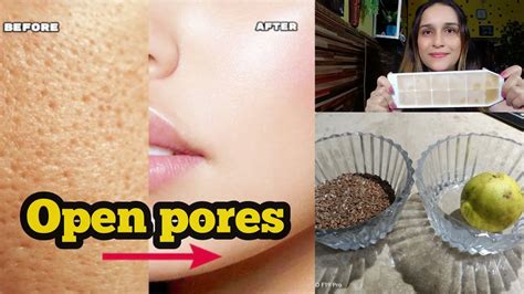 How To Minimize And Shrink Open Pores Naturally At Home Openpores Beautytips Homeramedy Youtube