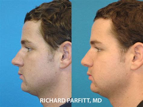 Other male patients prefer to have a slightly sloped profile with a supratip break and the tip raised to about 95 degrees. Male Plastic Surgery Before and After Photos