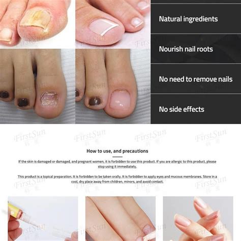 Fingernail fungus often occurs when moisture gets trapped under the nail bed. Fungus Infection On Hands #NailPolishForFungusTreatment ID ...