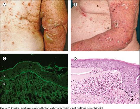 Figure 1 From Pemphigoid Diseases Semantic Scholar