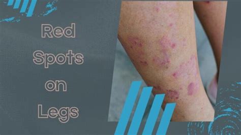 Red Spots On Legs Causes Small Itchy Non Itchy Dots On Legs 2023