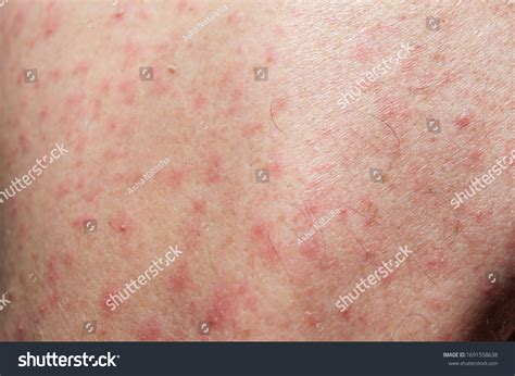 Purulent Rashes On Abdomen Man Allergy Stock Photo 1691558638