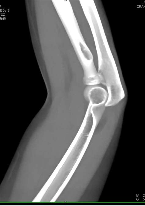 Positive Fat Pad Sign Elbow Following Trauma Trauma Case Studies