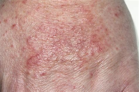 Pics Of Contact Dermatitis Rash Eczema On Hands My Xxx Hot Girl