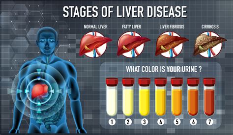 Stages Of Liver Disease Mcisaac Health Systems Inc