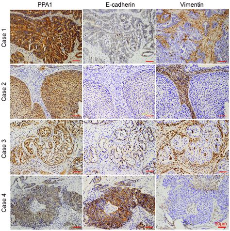 IHC staining revealed correlations between PPA1 and E-cadherin or 