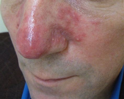 Rosacea Images And Videos News Releases Arsc