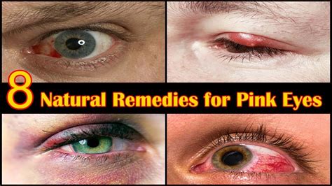 How To Get Rid Of Pink Eye Fast At Home 8 Home Remedies For Eye Infection Youtube