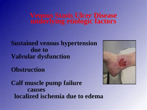 The Difference Between Venous And Arterial Ulcers Usa