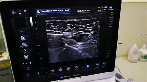 Ultrasound Guided Sciatic Popliteal Block Youtube