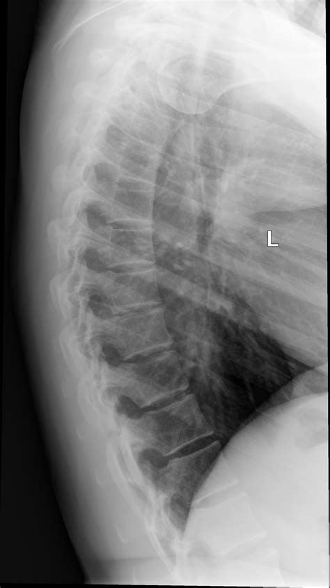 Lateral Thoracic Spine Radiograph With Multiple Mild Vertebral Hot Sex Picture