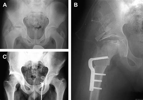 Principles Of Treating The Sequelae Of Perthes Disease Orthopedic Clinics