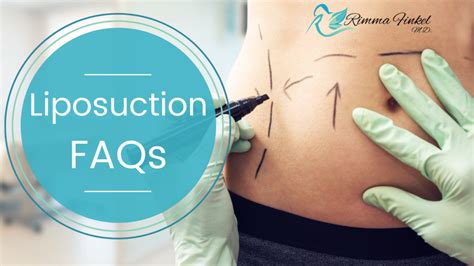 Liposuction FAQs Dr Finkel MD