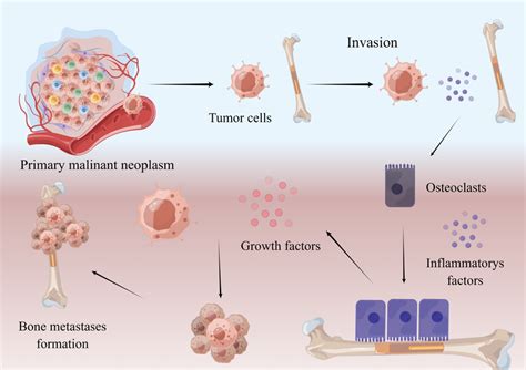 Mechanism Of Bone Metastasis Malignant Neoplasm Cells Break Away From