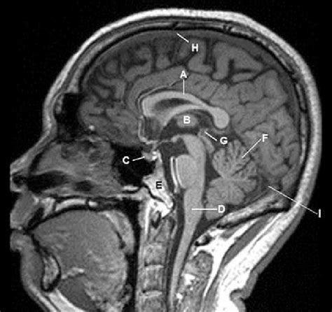 Normal Anatomy Of The Brain On Sagittal Plane T1weighted Magnetic