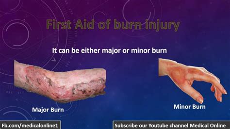 How To Treat Burn Injury Immediately First Aid Youtube