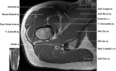 Supplemental Materials For Normal Mr Imaging Anatomy Of The Thigh And