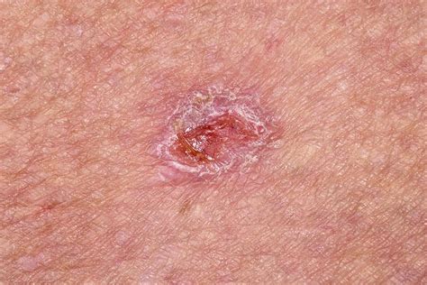 Basal Cell Carcinoma Skin Cancer Photograph By Dr P Marazzi Science Photo Library