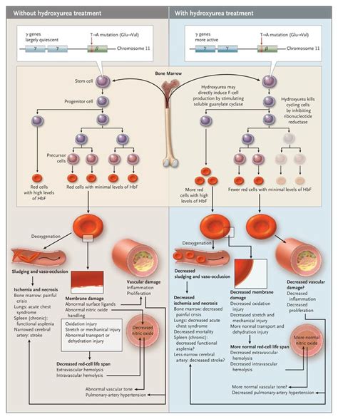 Hydroxyurea For The Treatment Of Sickle Cell Anemia Nejm