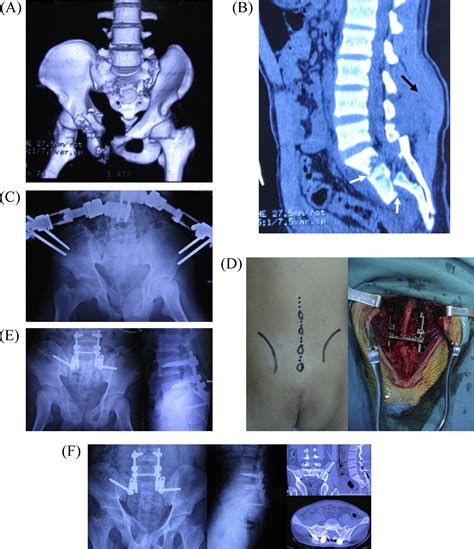 Lumbopelvic Fixation For Multiplanar Sacral Fractures With Spinopelvic