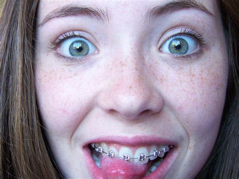 Girls With Braces Ar Twitter Cute Freckles Braces T Co Hot Sex Picture