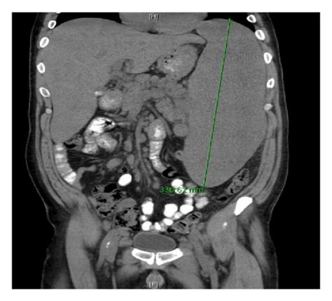 Diffuse Lymphadenopathy A Transverse Ct Of The Abdomen Showing