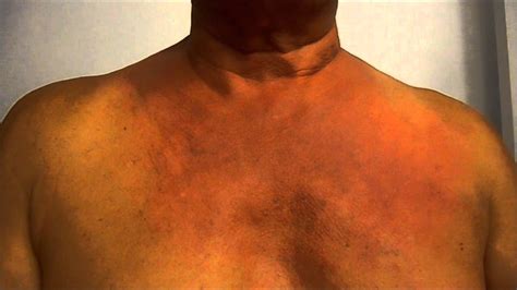 Dealing With A Vicious Itching Chest And Neck Rash Youtube
