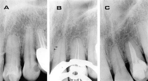 Dens Invaginatus In The Maxillary Lateral IncisorTreatment Of Cases