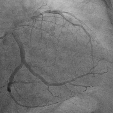 Localizing Intramyocardially Embedded Left Anterior Descending Artery