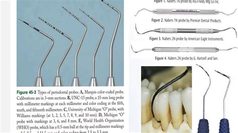 Periodontal Probing Department Of Periodontology And Oral