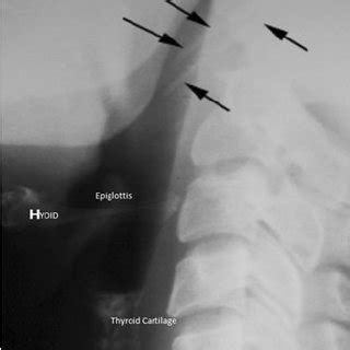 PDF Analysing Lateral Soft Tissue Neck Radiographs