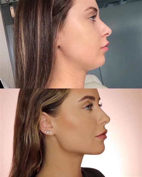 How To Get A More Defined Jawline With Injections Rapidement
