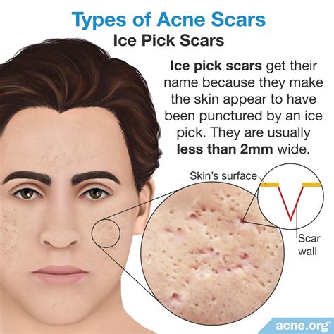 Acne Scar Treatments Guide
