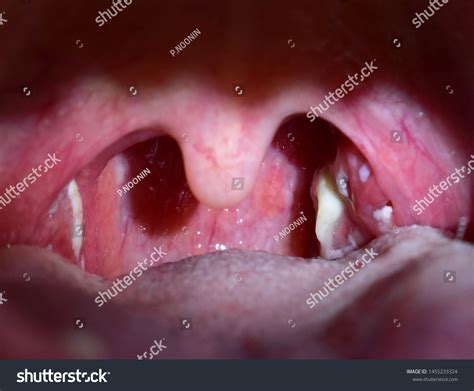 Tonsillitis Pus On Tonsils Throat Infection Foto De Stock