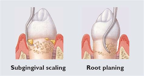 Periodontology 紫荊齒科 紫荆齿科 Dental Bauhinia