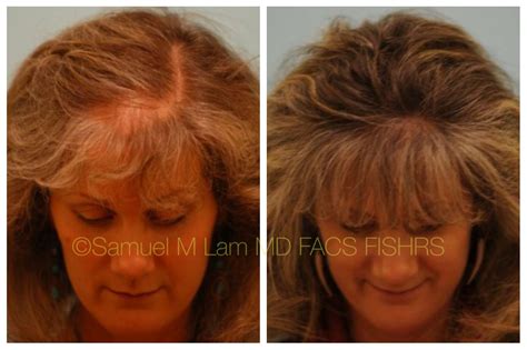 This 51 Year Old Woman Had Hair Loss In Her Central Midscalp And Is