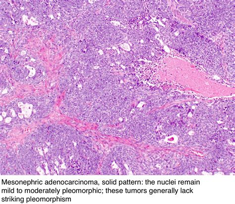 Pathology Outlines Mesonephric Adenocarcinoma