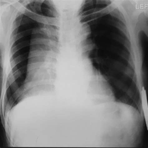 Chest X Ray Posteroanterior View Shows Mediastinal Widening Download