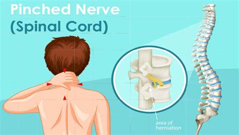 Pinched Nerve Pain Elkins Park Read The Chiropractic Blog