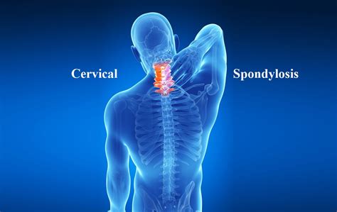 How To Cure Cervical Spondylosis Causes Symptoms And