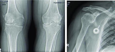 Radiologic Findings Showing Osteoarthrosis Joints A Bilateral Knee