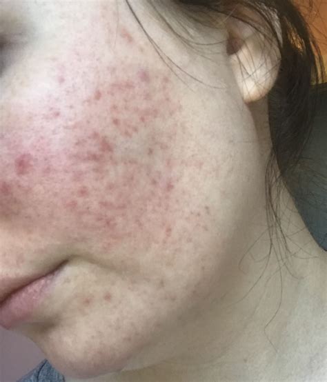 Is This Rosacea Rosacea And Facial Redness Forum