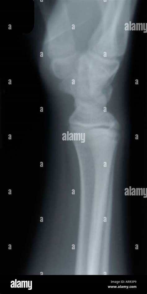 Normal Lateral View Of Juvenile Wrist X Ray Stock Photo Royalty Free